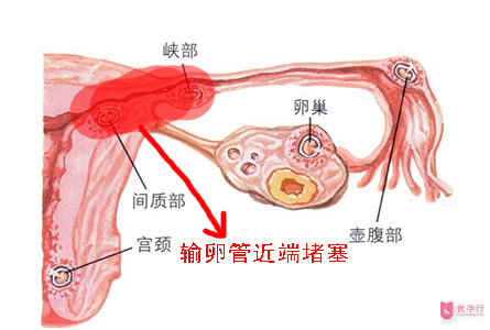 输卵管堵塞的相关知识，大多数人都不知道这个！