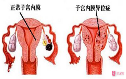 美国试管婴儿