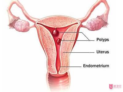 子宫息肉(2).jpg